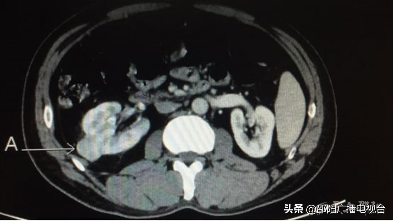 腹腔镜一侧肾脏切除手术,邵阳市腹腔镜微创治疗
