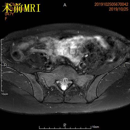 子宫腺肌症「不死的癌症」——介入栓塞来帮忙