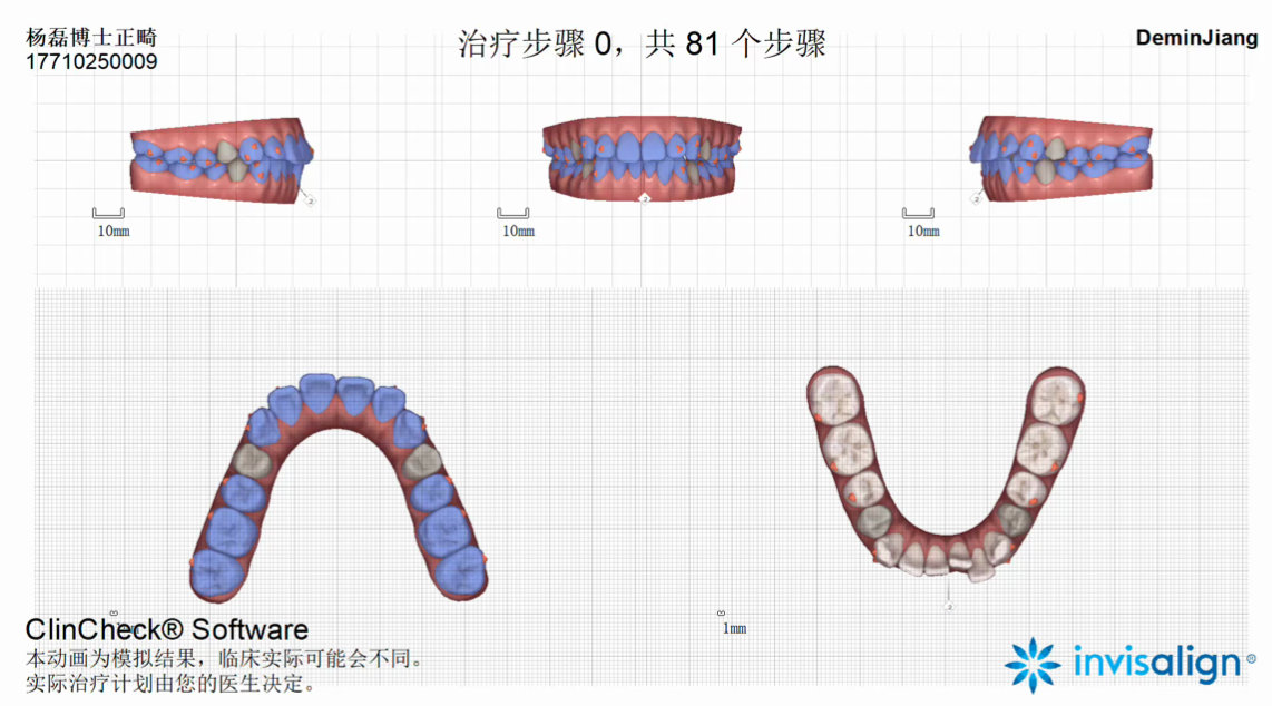 正畸医生杨磊,北大口腔医院修复科杨磊