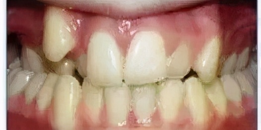 有一个牙齿凹陷怎么矫正,口呼吸导致牙齿畸形怎么矫正