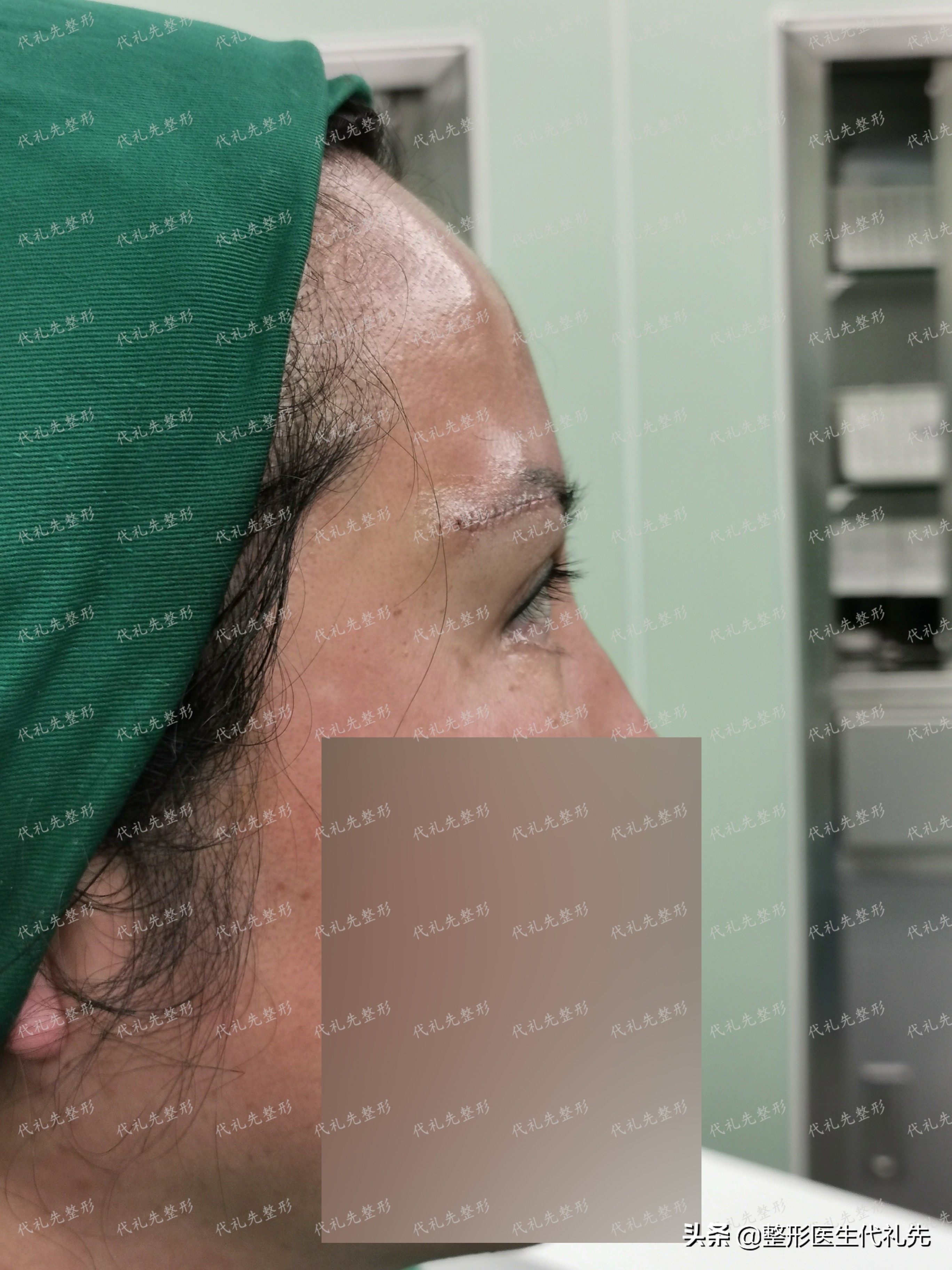 50岁做提眉眼袋手术能保持多久,提眉去眼袋手术15天图片