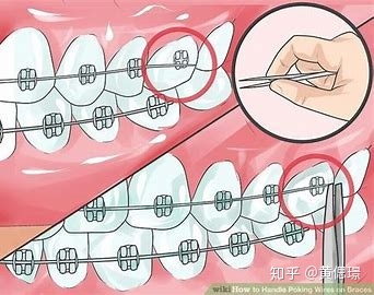 2021年春节期间牙套er应急自救指南