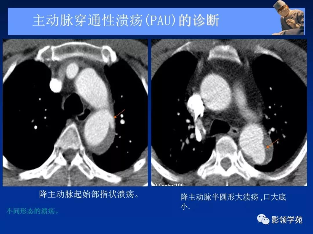 主动脉夹层壁间血肿如何鉴别,主动脉夹层血肿溃疡
