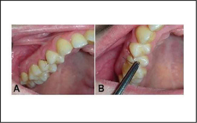 一女子患上罕见牙龈多毛症,牙齿里竟然长出了毛发