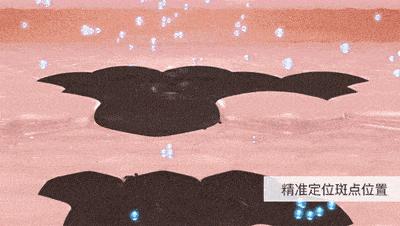 雀斑是遗传性还是后天性?普及一下雀斑更多可能的形成原因