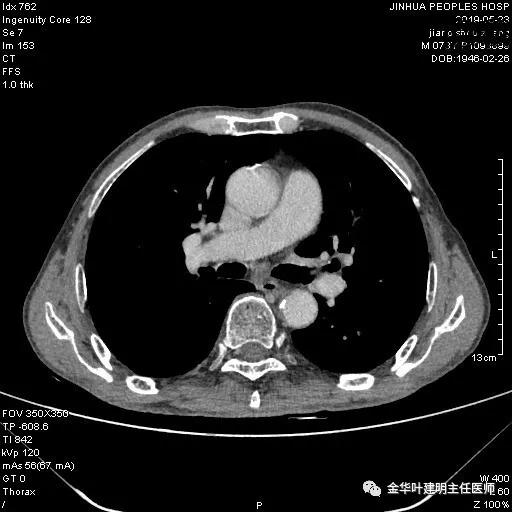 手术引起乳糜胸,有没有做了肺结节手术后是误诊的