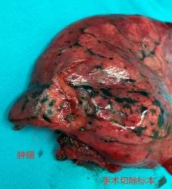 微创医疗最新突破,首例单孔胸腔镜手术