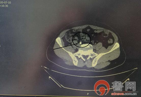 先天性独肾得了肾结石怎么治疗好,孤立肾多发肾结石要及时治疗吗