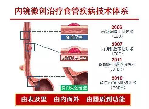 内镜治疗的最新技术,内镜下内镜治疗的创新点