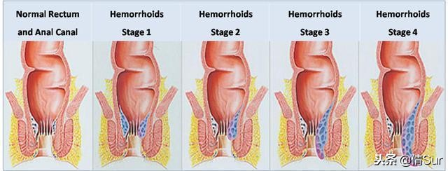 排便不顺、便血、便秘、肛门肿痛?妊娠期痔疮如何预防和缓解?