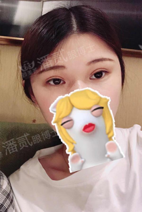 什么样的肿眼泡适合全切,什么样的肿眼泡不用动提肌