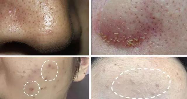 姘ㄥ熀閰稿噣閫忕編鐧芥磥闈钩鐩存挱,姘ㄥ熀閰告场娌礂闈㈠ザ缇庣櫧鐩存挱