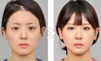 关于瘦脸针的小常识你都了解多少,瘦脸针人人都可以打吗科普篇