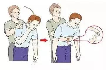 女子咳嗽20年竟因鸡骨头卡气管,大人痰卡住气管急救方法