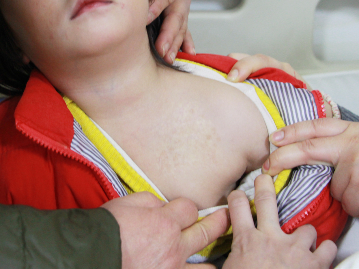 乳房血管瘤用什么方法治最好,乳房上有樱桃状血管瘤怎么治