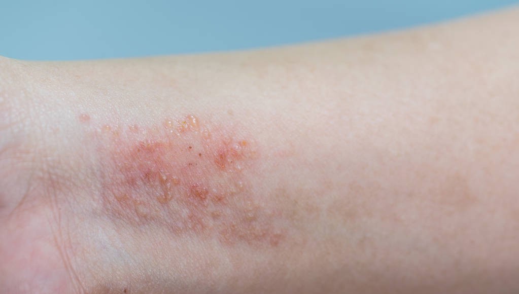 中医治疗特应性皮炎过敏,特应性皮炎能医断根吗