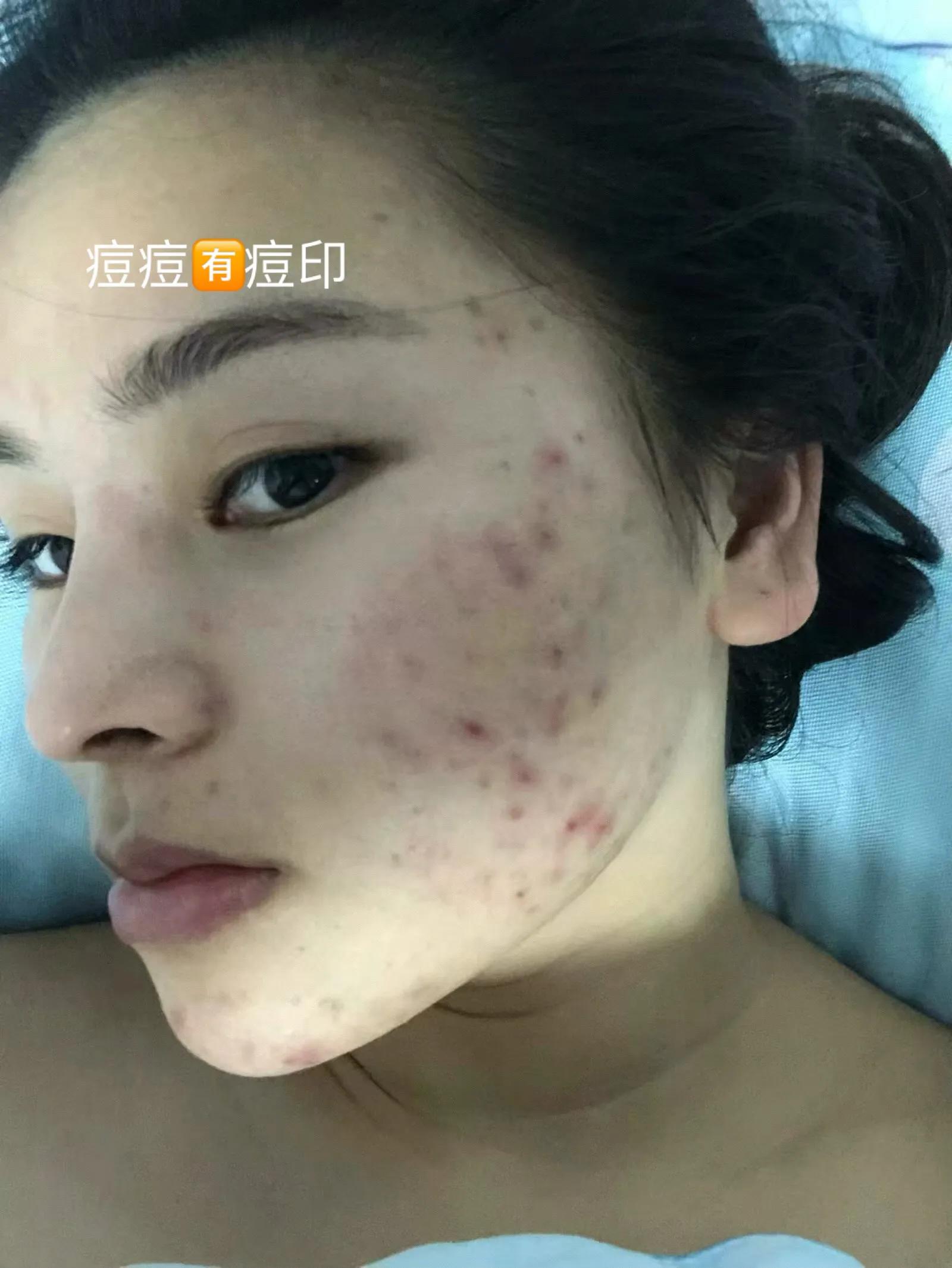 30天快速消痘印,30天祛痘效果最好的方法