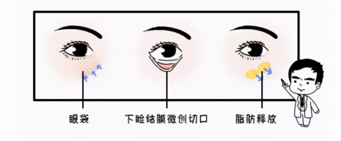 割眼袋是外切好还是内切好,割眼袋内切和外切有什么区别