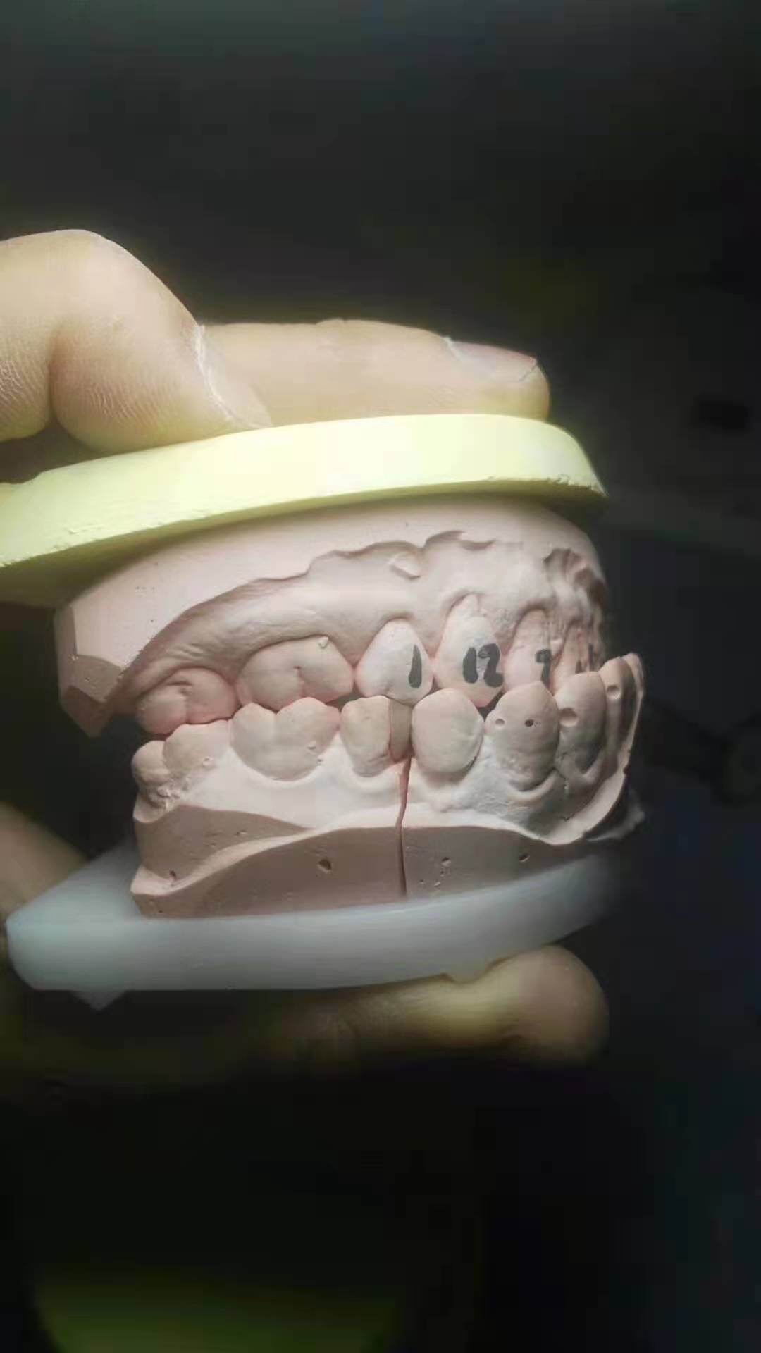 假牙套怎么种植牙,戴的假牙套与全瓷牙的感觉