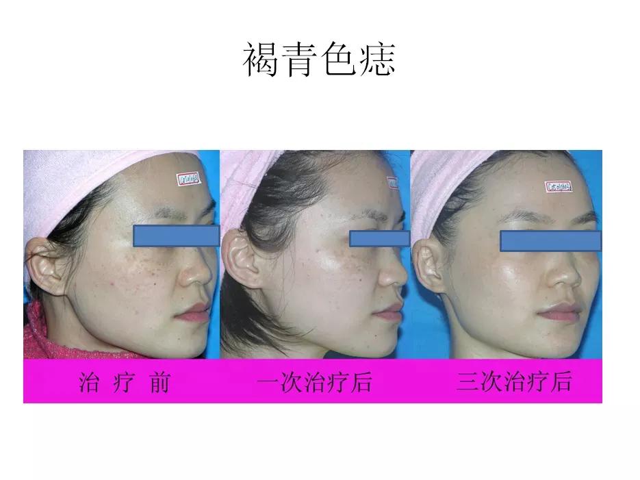 微微之光，让我记住你的美——陕西省皮防所医院超皮秒、热玛吉媒体专场活动圆满结束