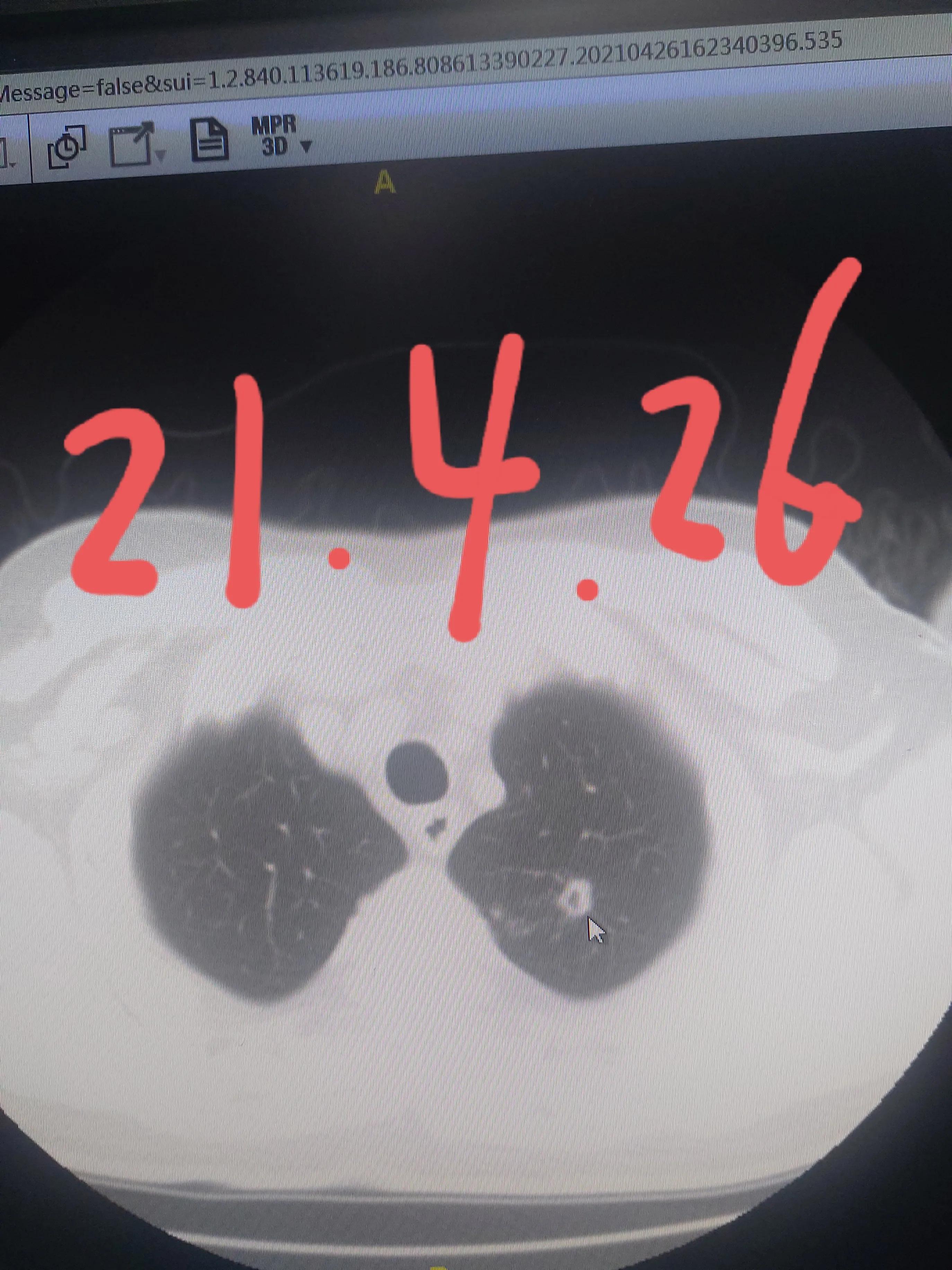 刘懿博士肺癌治疗,刘懿博士说肺癌晚期合并脑梗