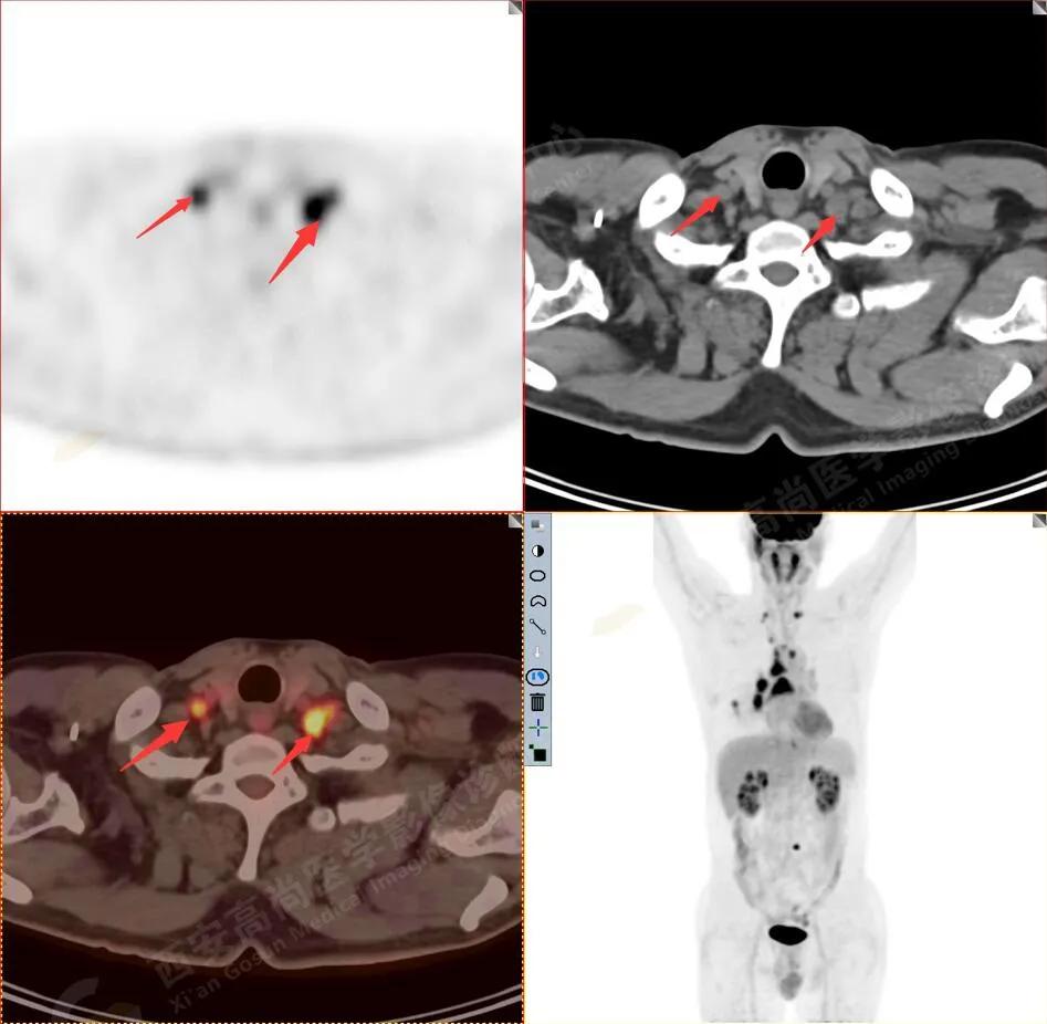 petct检查报告肺结节考虑恶性肿瘤,30mm肺结节pet显示没有转移
