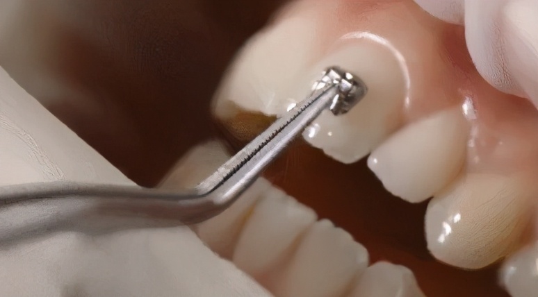 牙齿脱矿了如何补救,牙齿脱矿了怎么治