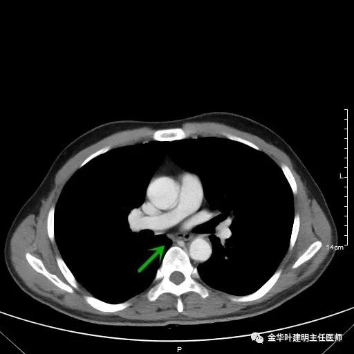 伴有脑转移了的肺癌能手术吗？