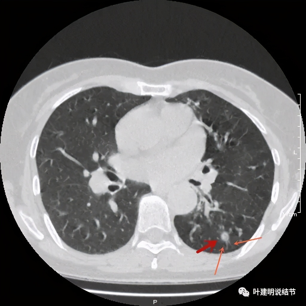 这样的实性结节伴小空洞会是肺癌吗?