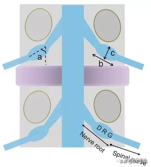腰椎手术后神经根水肿要怎样治疗,腰椎融合术后神经根水肿吃中药