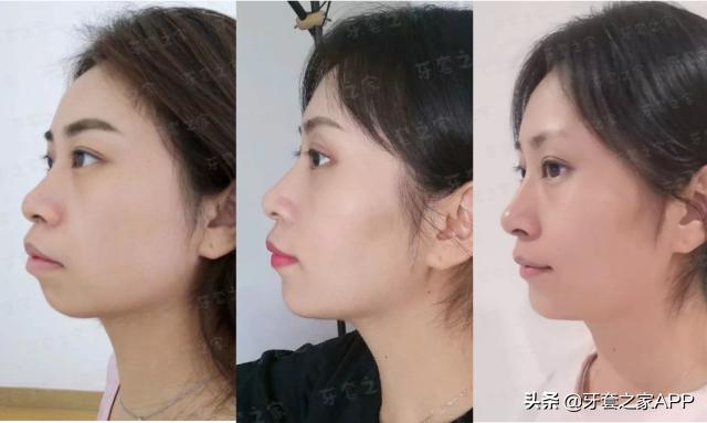 拔牙和打骨钉哪个更痛,矫正牙齿拔牙后一定要打骨钉吗