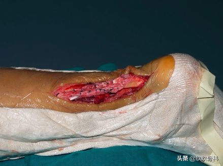 陈旧性踝关节损伤的治疗,踝关节损伤现场处理视频