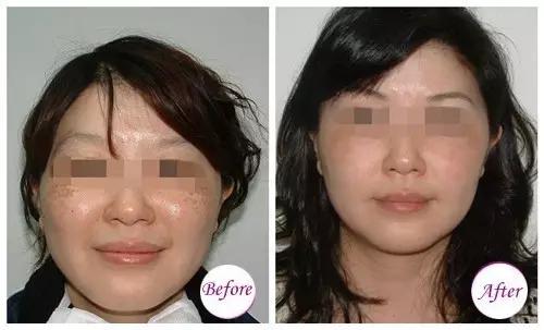 激光超皮秒祛斑后需要注意什么,激光祛斑后反黑了可以再去激光吗