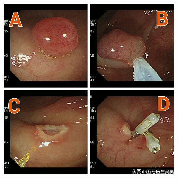 切息肉需要停阿司匹林吗,服用阿司匹林不能手术吗
