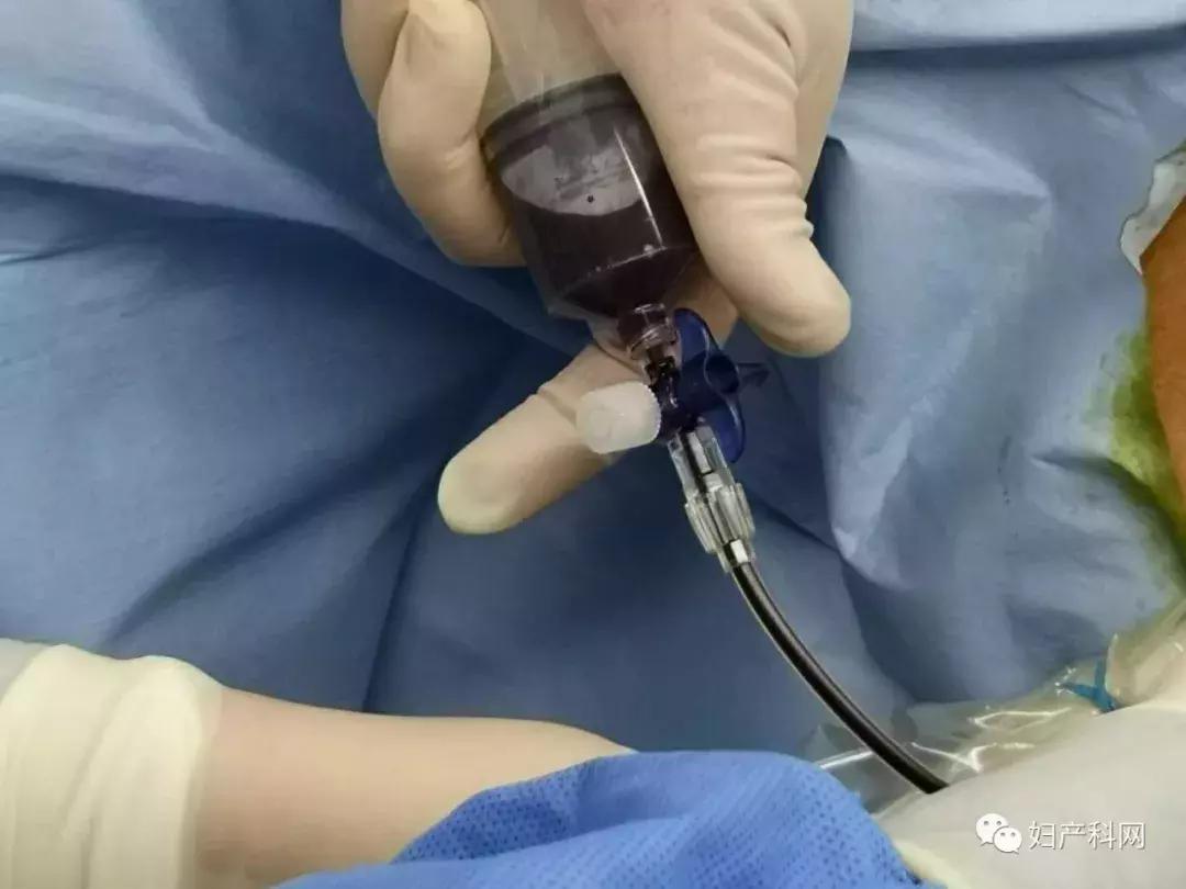 微·无创|NO.22病例分享之经阴道卵巢囊肿穿刺