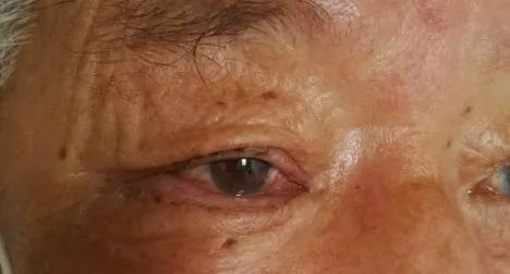 眼整形常见手术方式,眼整形美容手术