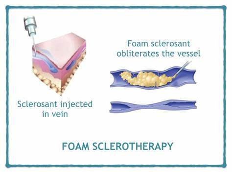 腿上有蜘蛛网是怎么回事,腿上结蜘蛛网是什么