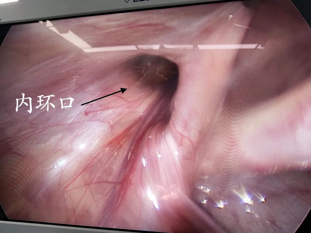 孩子腹部胀大,小孩腹部有个小鼓包