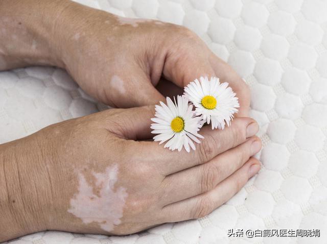 手上长白块还掉皮怎么回事,手上长的白块是什么