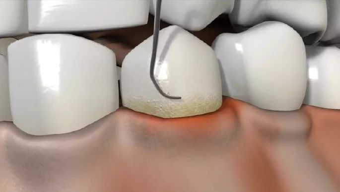 多图直击！牙医如何用抛光把孩子的牙洗干净？#葉子口腔科普#