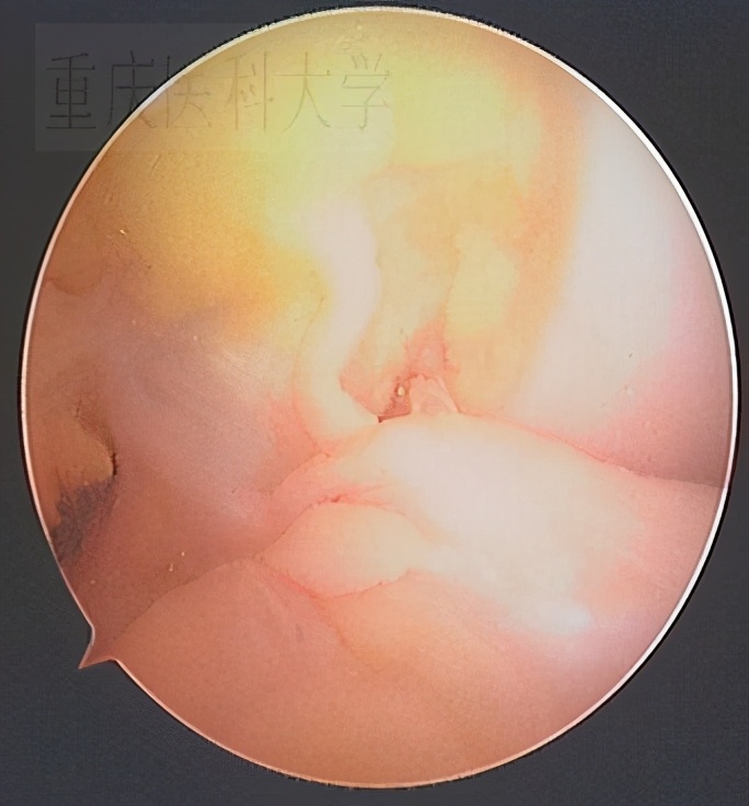 前交叉韧带损伤核磁共振,前后交叉韧带损伤的治疗