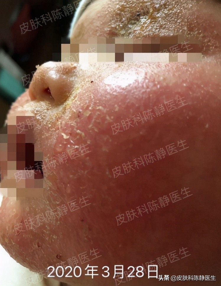 求治宝宝湿疹方法,宝宝湿疹给宝妈支招