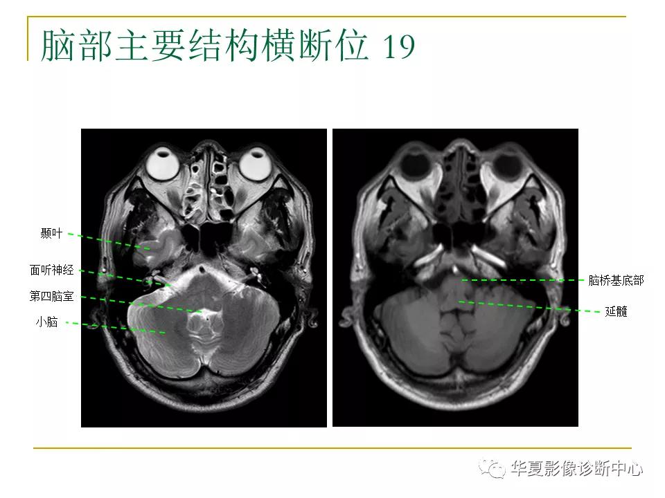 中国人脑立体定向mri应用解剖图谱,脑mri示意图