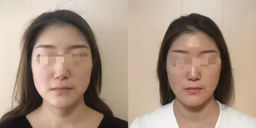 日式小颜整骨需要具备什么,日式小颜整骨术可以把额头变宽吗