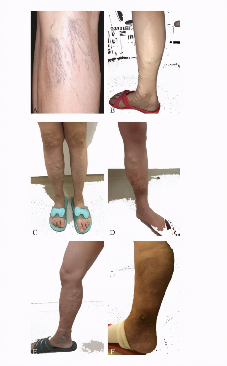 工作引起静脉曲张怎么办,下肢静脉曲张属于职业病吗