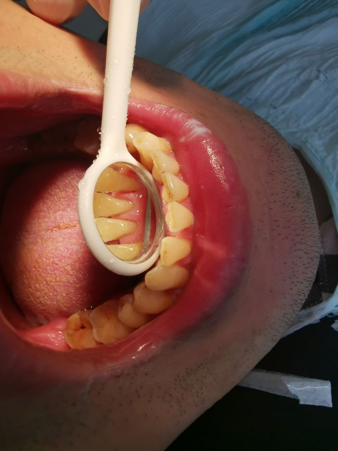 洗牙到底好不好,喷砂洗牙到底好不好