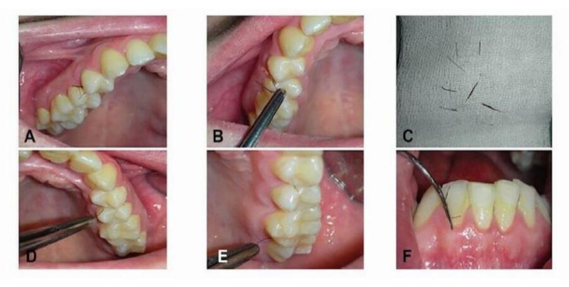 一女子患上罕见牙龈多毛症,牙齿里竟然长出了毛发