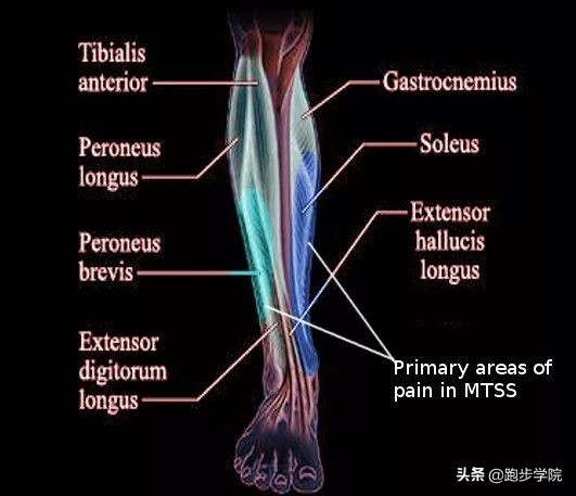 伤害了1/3跑者的胫骨炎，请务必重视起来