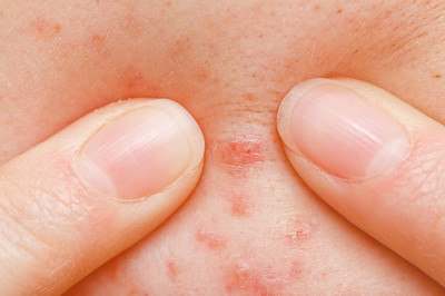 孩子长青春痘时正确的处理方法,青春期孩子长青春痘烦躁