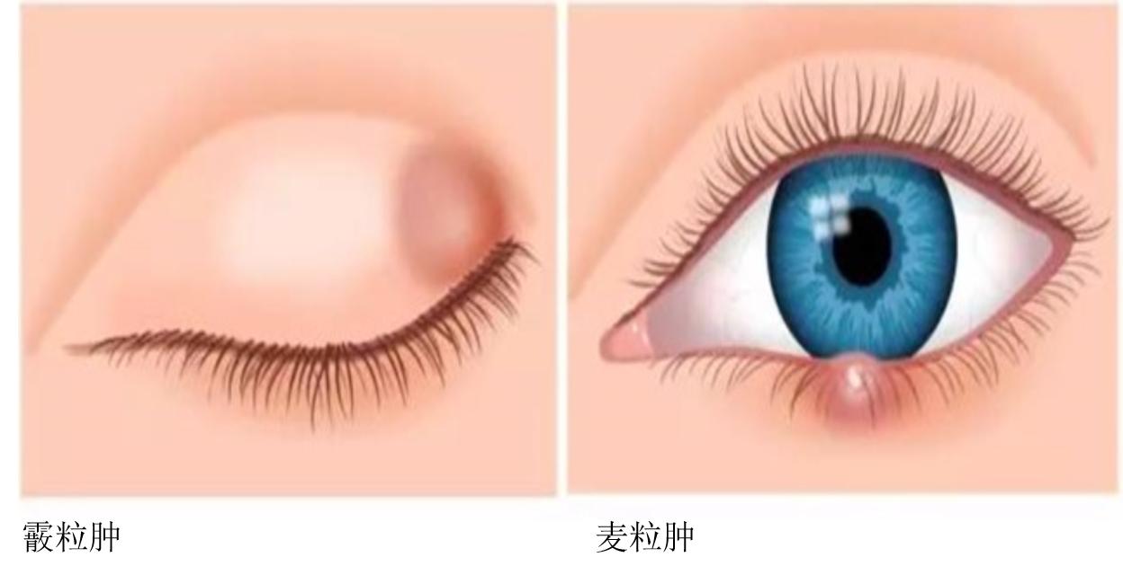 小孩麦粒肿和霰粒肿的区别,霰粒肿和麦粒肿是一样的吗